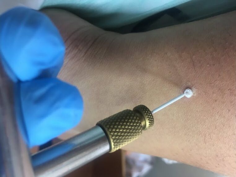 tüükade eemaldamise viisid