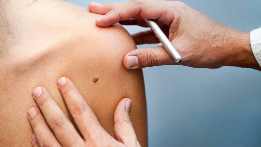 Dermatoloog uurib papilloomiga patsienti
