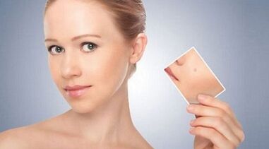 Tüügaste ja papilloomide tõhusate vahendite ülevaade