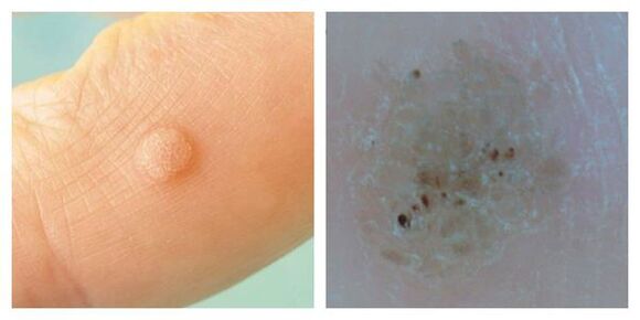 Tavaline tüügas eksami ja dermatoskoopia ajal