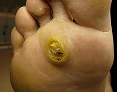 Subanaari papilloomid